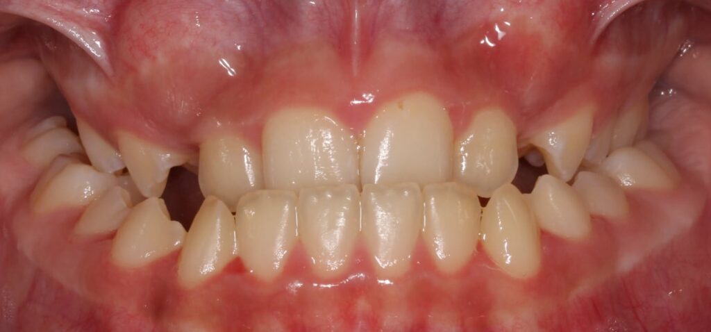 Underbite Together Pediatric Dentistry & Orthodontics in Annandale, VA