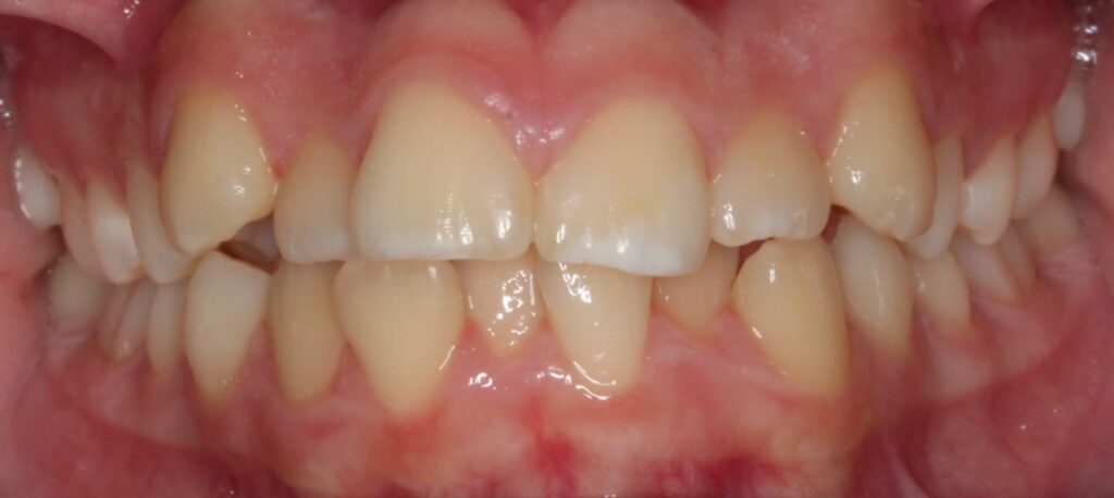 Crowding Together Pediatric Dentistry & Orthodontics in Annandale, VA