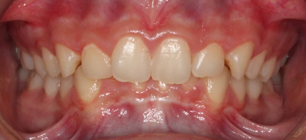Deep bite Together Pediatric Dentistry & Orthodontics in Annandale, VA