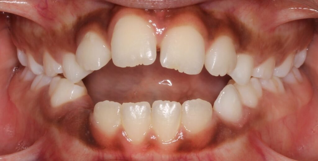 Open bite Together Pediatric Dentistry & Orthodontics in Annandale, VA